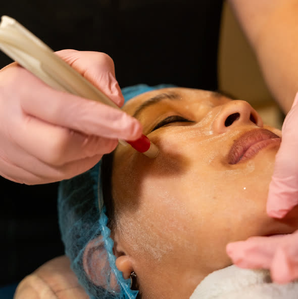 Procedimiento facial con instrumento sobre la mejilla de una paciente